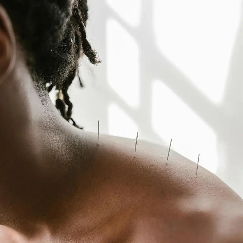 Acupuncture treatment with thin needles placed in shoulder muscles for pain relief and relaxation