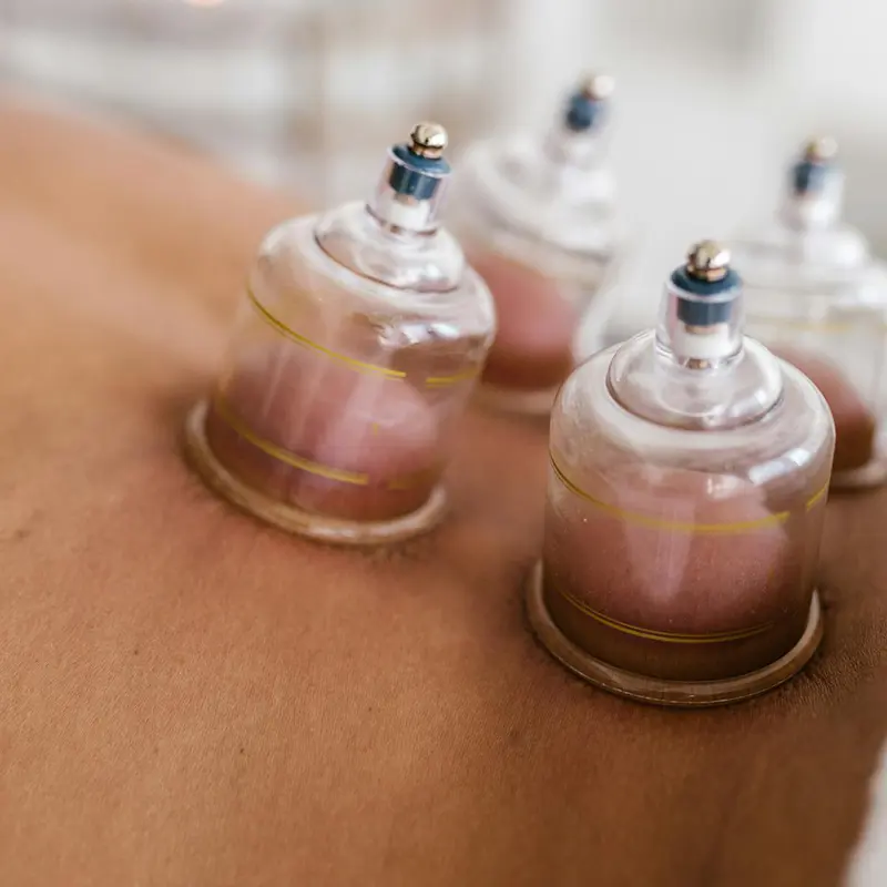 Cupping therapy treatment with vacuum suction cups placed on back to improve circulation and relieve muscle tension