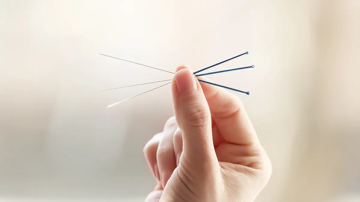 Close-up of hand with acupuncture needles during therapy session