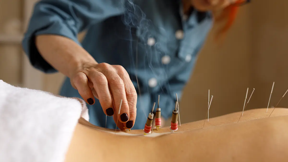 Therapist using heated moxa on patient’s back for healing